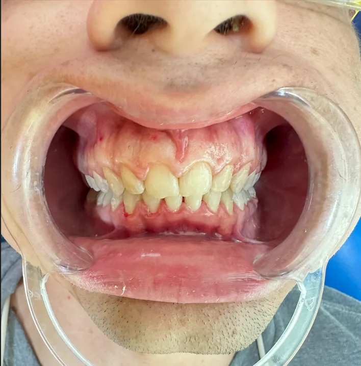 Antes ortodoncia y corte de encías Smile Care