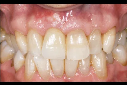 Después implante dental Smile Care
